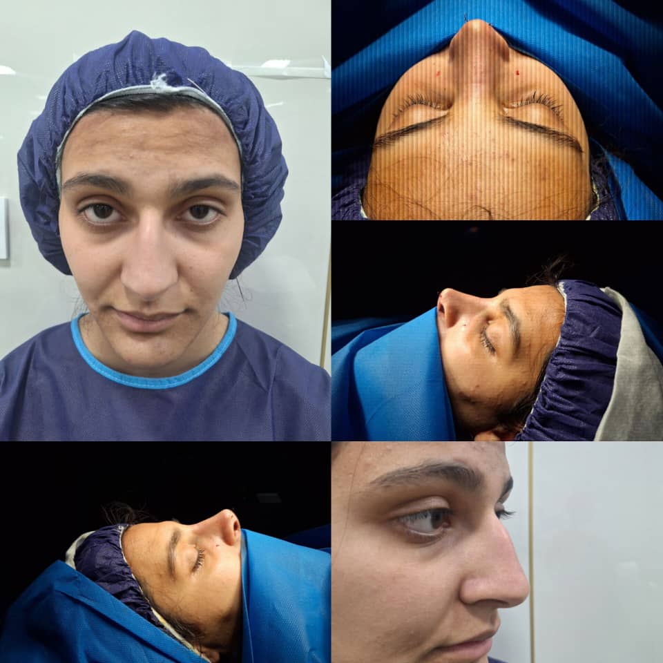جراحی بینی طبیعی